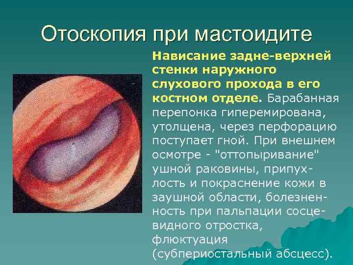 Отоскопия при мастоидите Нависание задне-верхней стенки наружного слухового прохода в его костном отделе. Барабанная