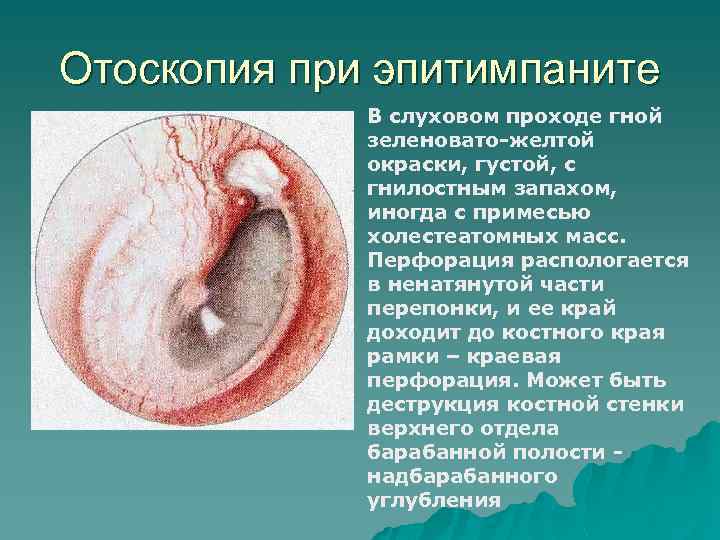 Отоскопия при эпитимпаните В слуховом проходе гной зеленовато-желтой окраски, густой, с гнилостным запахом, иногда