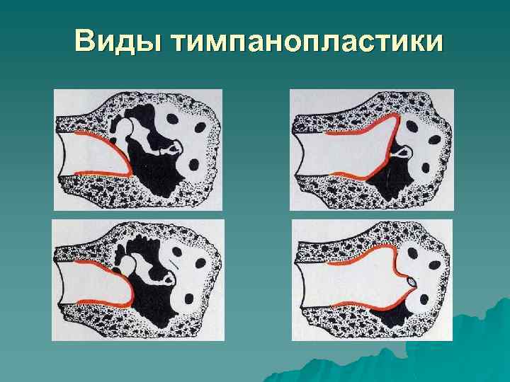 Виды тимпанопластики 