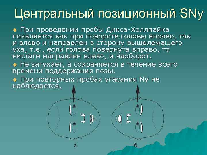 Центральный позиционный SNy При проведении пробы Дикса-Холлпайка появляется как при повороте головы вправо, так