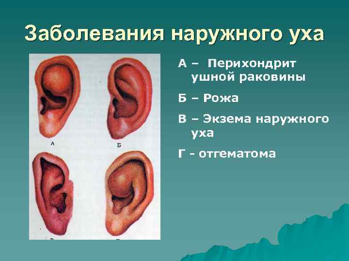 Заболевания наружного уха А – Перихондрит ушной раковины Б – Рожа В – Экзема