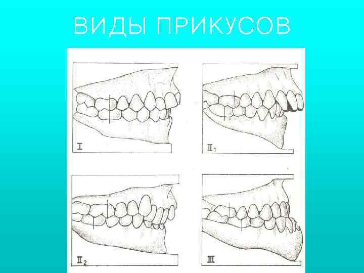 Типы окклюзии