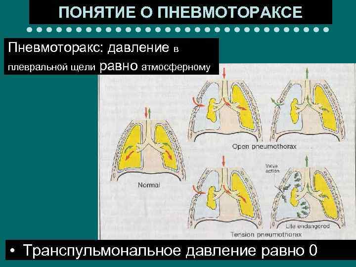 ПОНЯТИЕ О ПНЕВМОТОРАКСЕ Пневмоторакс: давление в плевральной щели равно атмосферному • Транспульмональное давление равно