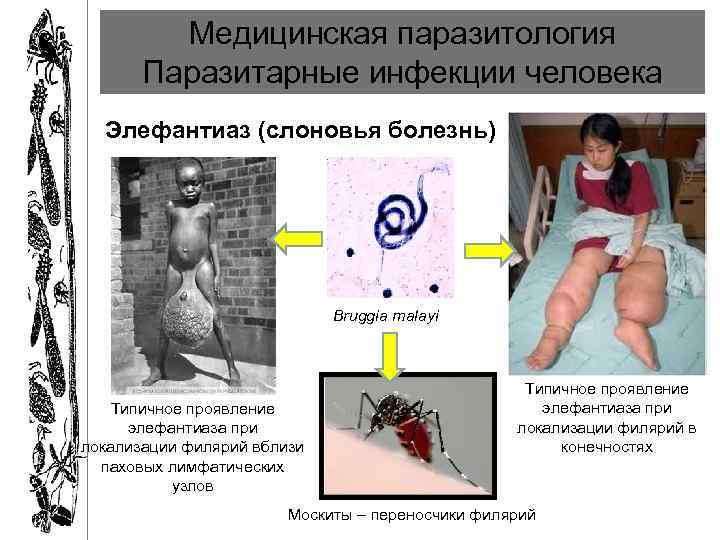 Медицинская паразитология Паразитарные инфекции человека Элефантиаз (слоновья болезнь) Bruggia malayi Типичное проявление элефантиаза при