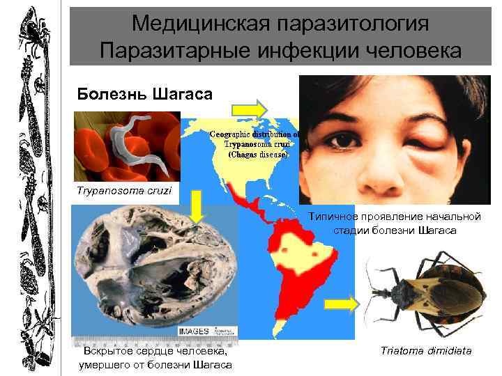 Медицинская паразитология Паразитарные инфекции человека Болезнь Шагаса Trypanosoma cruzi Типичное проявление начальной стадии болезни