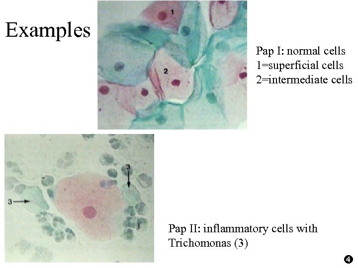 Examples Pap I: normal cells 1=superficial cells 2=intermediate cells Pap II: inflammatory cells with