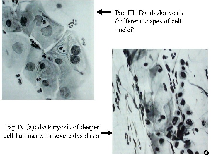 Pap III (D): dyskaryosis (different shapes of cell nuclei) Pap IV (a): dyskaryosis of