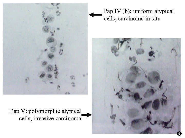 Pap IV (b): uniform atypical cells, carcinoma in situ Pap V: polymorphic atypical cells,