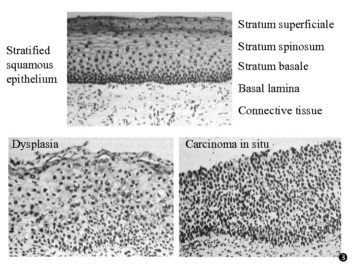 Stratum superficiale Stratified squamous epithelium Stratum spinosum Stratum basale Basal lamina Connective tissue Dysplasia