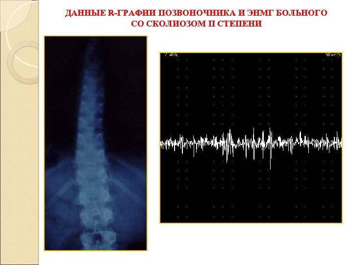 ДАННЫЕ R-ГРАФИИ ПОЗВОНОЧНИКА И ЭНМГ БОЛЬНОГО СО СКОЛИОЗОМ II СТЕПЕНИ 