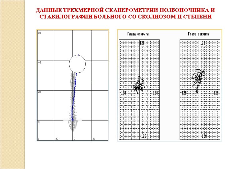 ДАННЫЕ ТРЕХМЕРНОЙ СКАНЕРОМЕТРИИ ПОЗВОНОЧНИКА И СТАБИЛОГРАФИИ БОЛЬНОГО СО СКОЛИОЗОМ II СТЕПЕНИ 