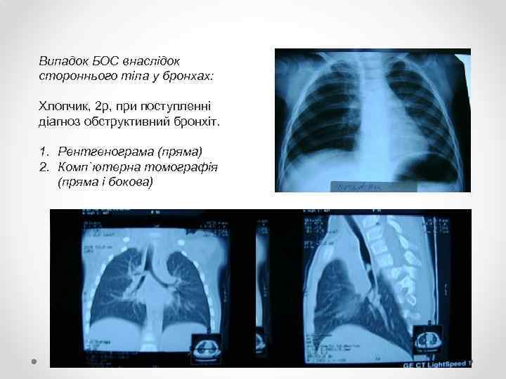 Випадок БОС внаслідок стороннього тіла у бронхах: Хлопчик, 2 р, при поступленні діагноз обструктивний