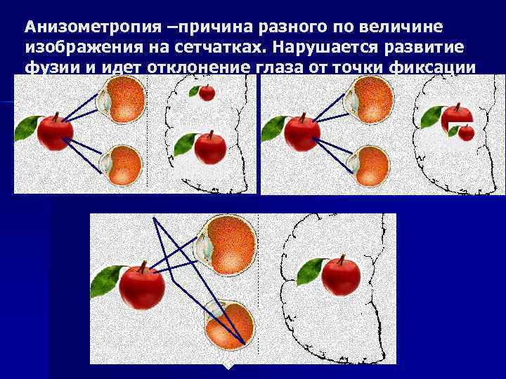 Анизометропия –причина разного по величине изображения на сетчатках. Нарушается развитие фузии и идет отклонение