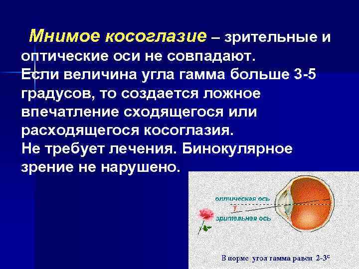 Мнимое косоглазие – зрительные и оптические оси не совпадают. Если величина угла гамма больше