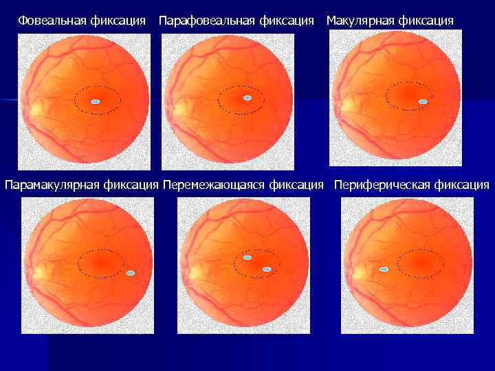 Фовеальная фиксация Парафовеальная фиксация Макулярная фиксация Парамакулярная фиксация Перемежающаяся фиксация Периферическая фиксация 