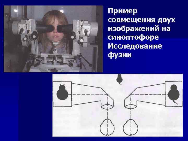 Пример совмещения двух изображений на синоптофоре Исследование фузии 