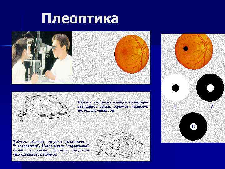 Плеоптика 