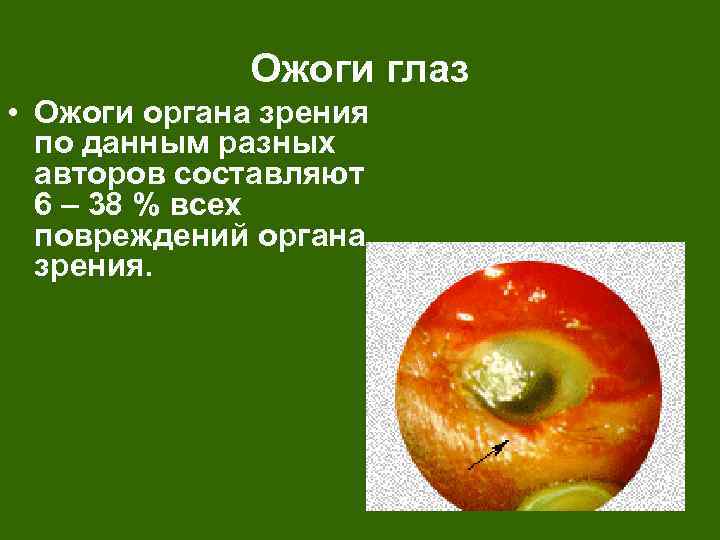 Ожоги глаз • Ожоги органа зрения по данным разных авторов составляют 6 – 38