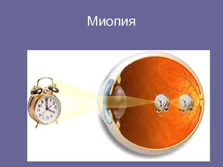 Миопия 