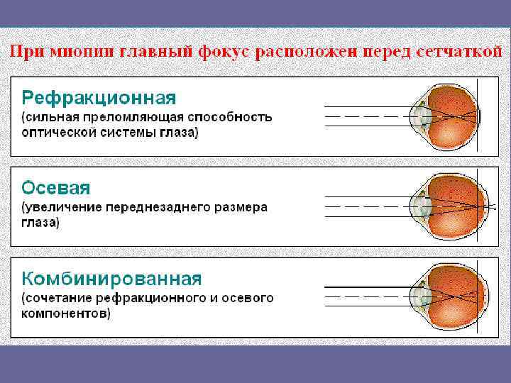 Состояние покоя аккомодации фокус на сетчатке рисунок