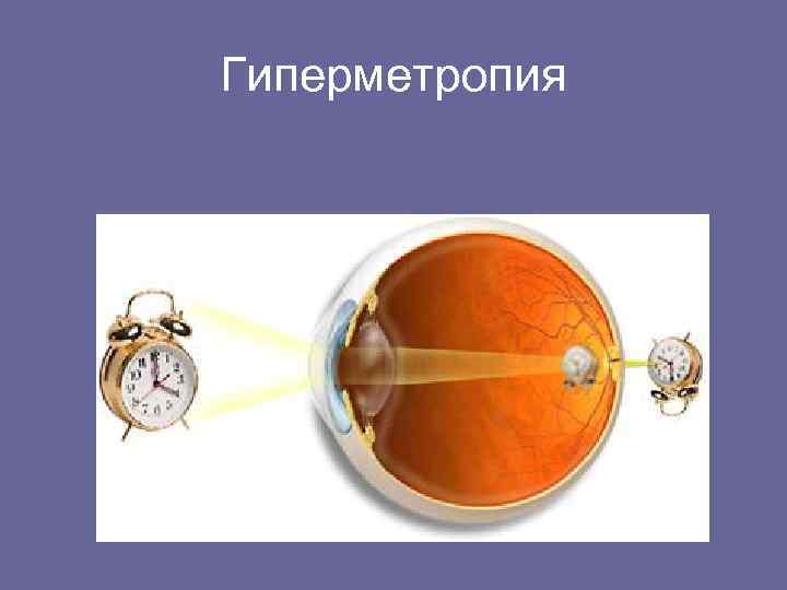 Гиперметропия 