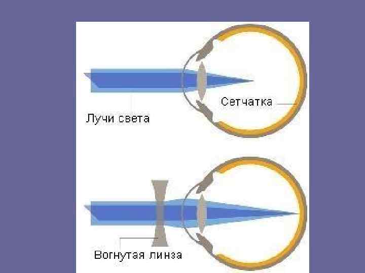 Если глаз человека строит изображение далеких предметов за сетчаткой то