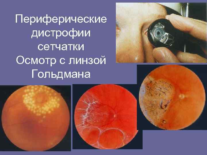 Периферические дистрофии сетчатки Осмотр с линзой Гольдмана 