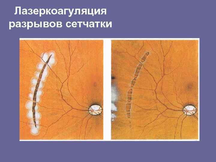 Лазеркоагуляция разрывов сетчатки 