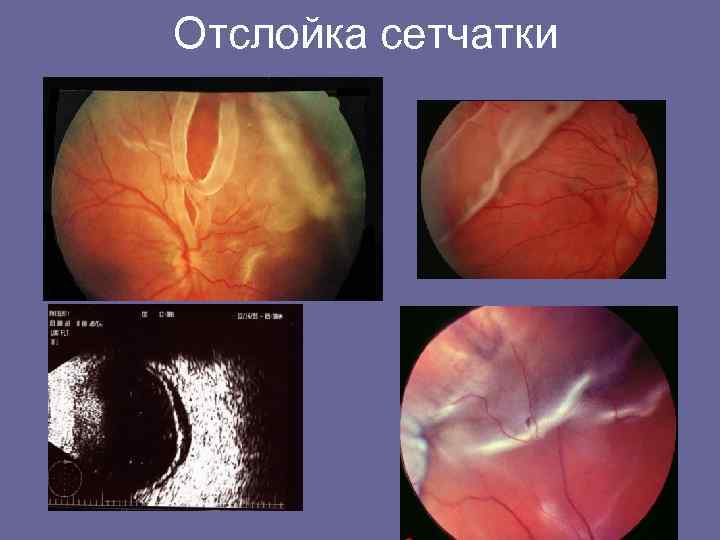 Отслойка сетчатки 