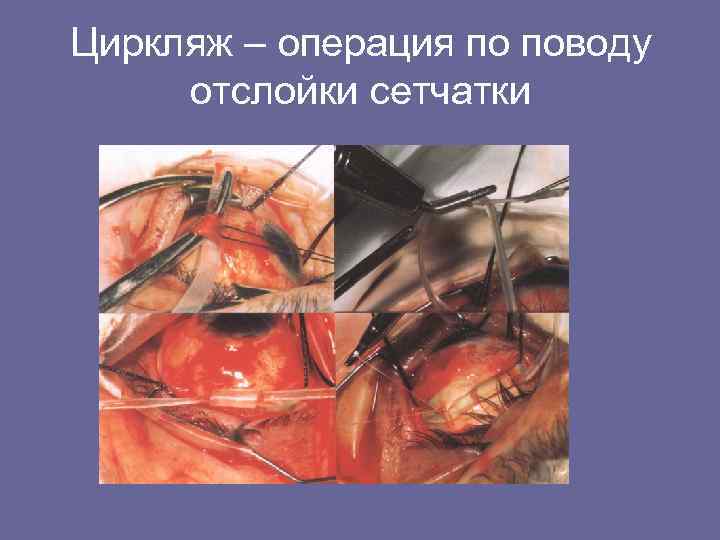 Циркляж – операция по поводу отслойки сетчатки 