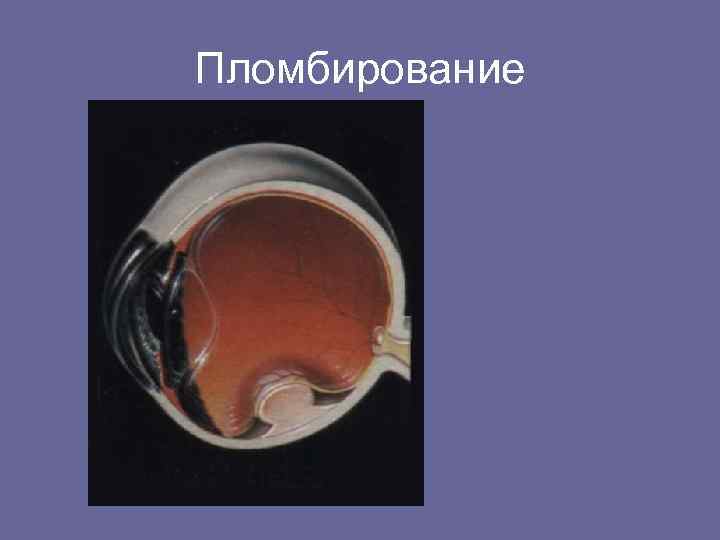 Пломбирование 