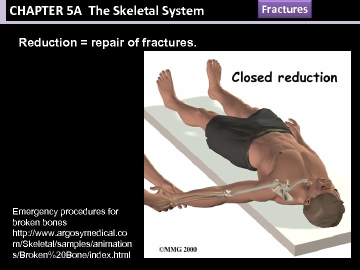 CHAPTER 5 A The Skeletal System Reduction = repair of fractures. Emergency procedures for