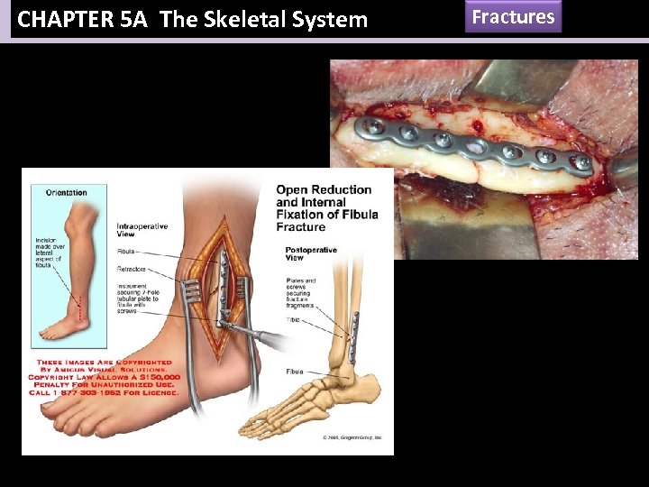 CHAPTER 5 A The Skeletal System Fractures 