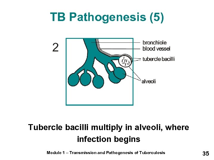 TB Pathogenesis (5) Tubercle bacilli multiply in alveoli, where infection begins Module 1 –
