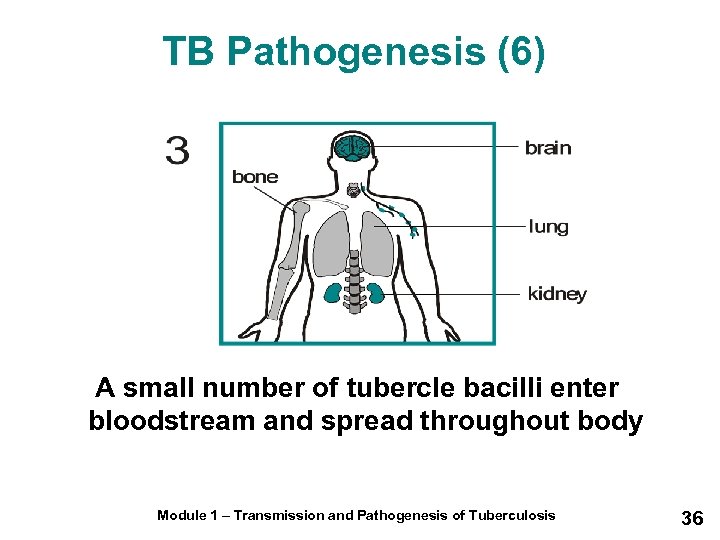 TB Pathogenesis (6) A small number of tubercle bacilli enter bloodstream and spread throughout