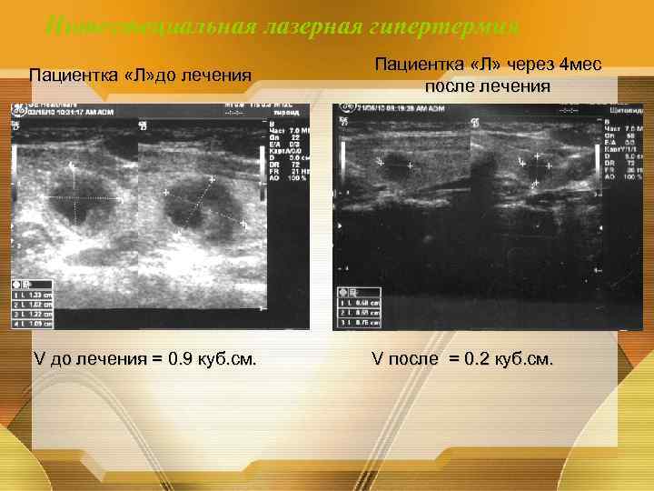 Интестециальная лазерная гипертермия Пациентка «Л» до лечения V до лечения = 0. 9 куб.