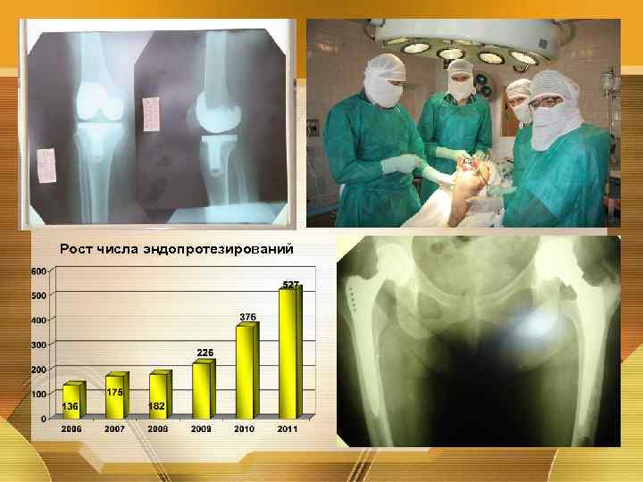 Рост числа эндопротезирований 