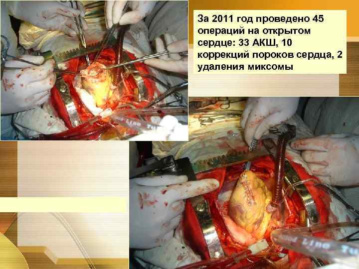 За 2011 год проведено 45 операций на открытом сердце: 33 АКШ, 10 коррекций пороков