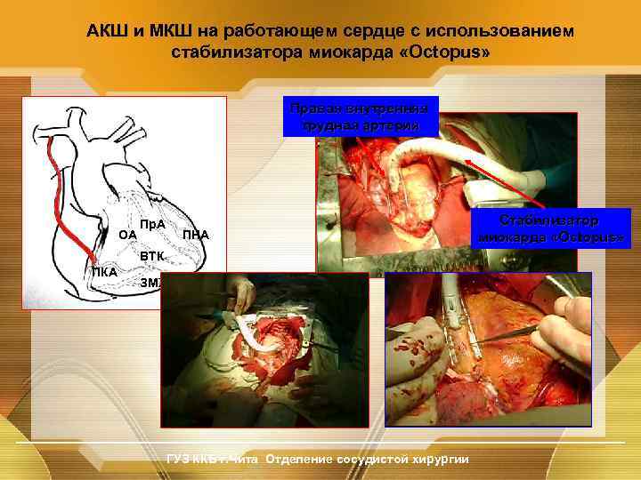 АКШ и МКШ на работающем сердце с использованием стабилизатора миокарда «Octopus» Правая внутренняя грудная