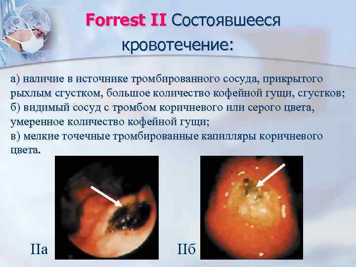 Forrest II Состоявшееся кровотечение: а) наличие в источнике тромбированного сосуда, прикрытого рыхлым сгустком, большое