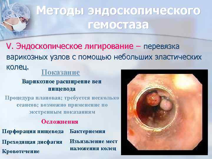 Методы эндоскопического гемостаза V. Эндоскопическое лигирование – перевязка варикозных узлов с помощью небольших эластических