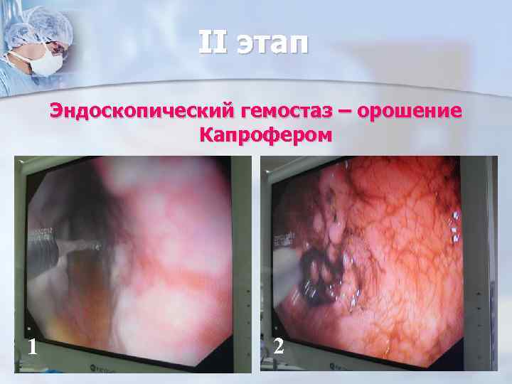 II этап Эндоскопический гемостаз – орошение Капрофером 1 2 