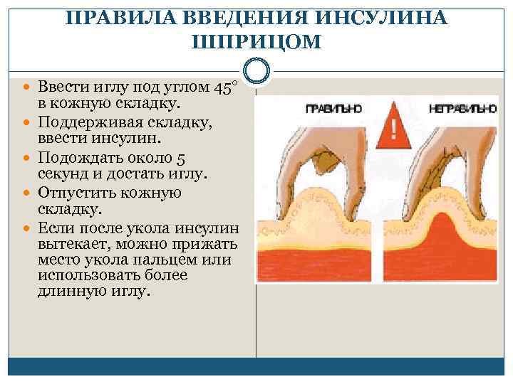 ПРАВИЛА ВВЕДЕНИЯ ИНСУЛИНА ШПРИЦОМ Ввести иглу под углом 45 в кожную складку. Поддерживая складку,