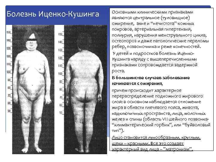 Болезнь Иценко-Кушинга Основными клиническими признаками являются центральное (туловищное) ожирение, акне и “нечистота” кожных покровов,