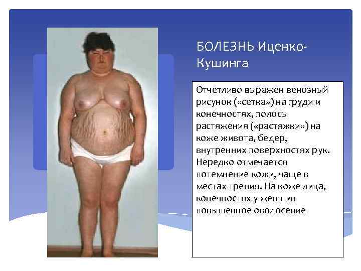 БОЛЕЗНЬ Иценко. Кушинга Отчетливо выражен венозный рисунок ( «сетка» ) на груди и конечностях,