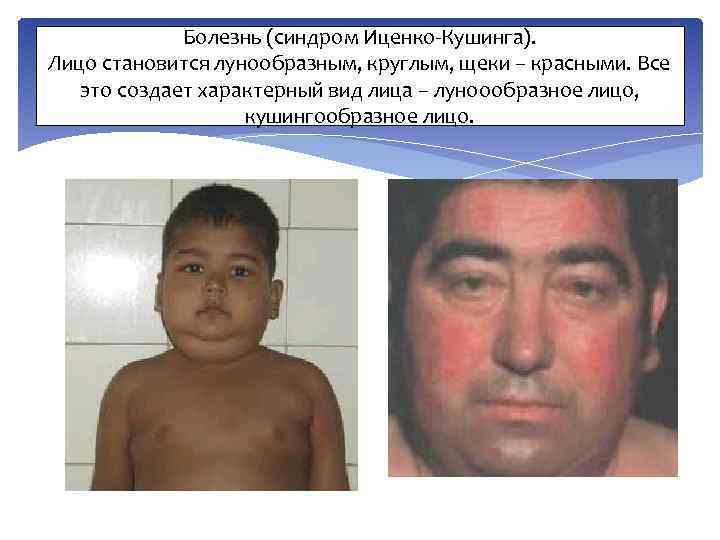 Болезнь (синдром Иценко-Кушинга). Лицо становится лунообразным, круглым, щеки – красными. Все это создает характерный
