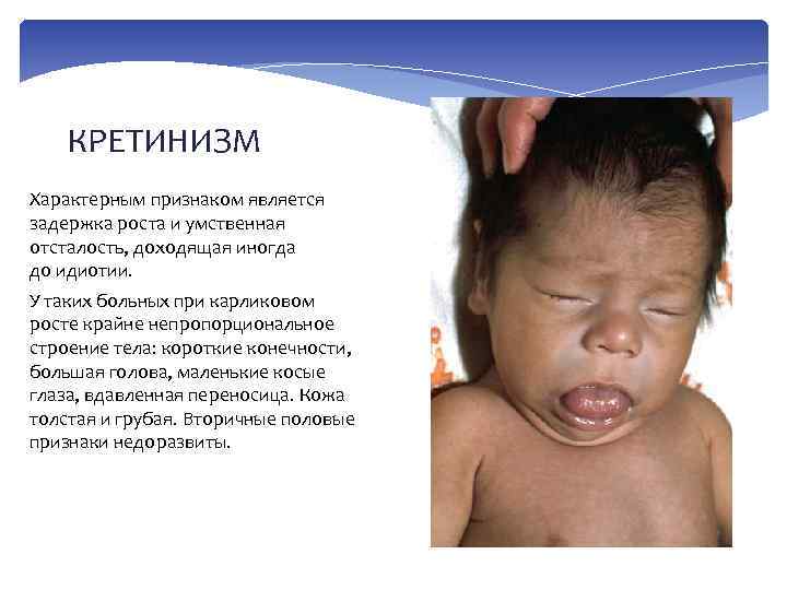 КРЕТИНИЗМ Характерным признаком является задержка роста и умственная отсталость, доходящая иногда до идиотии. У