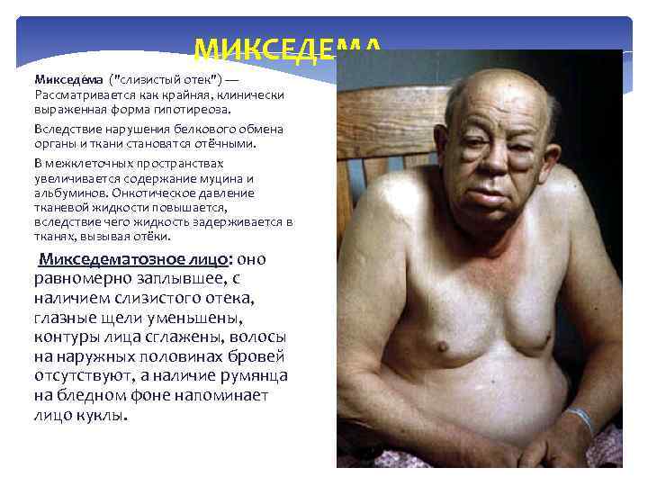 МИКСЕДЕМА Микседе ма (