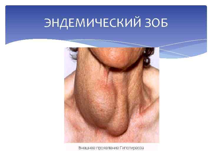 ЭНДЕМИЧЕСКИЙ ЗОБ 