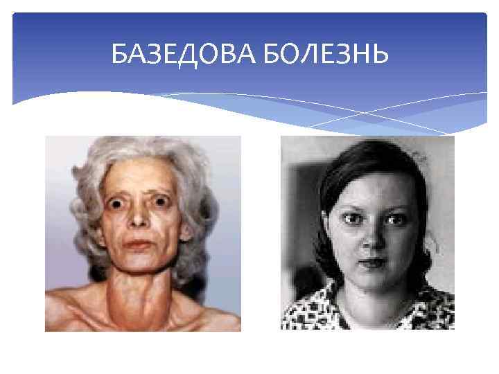 БАЗЕДОВА БОЛЕЗНЬ 
